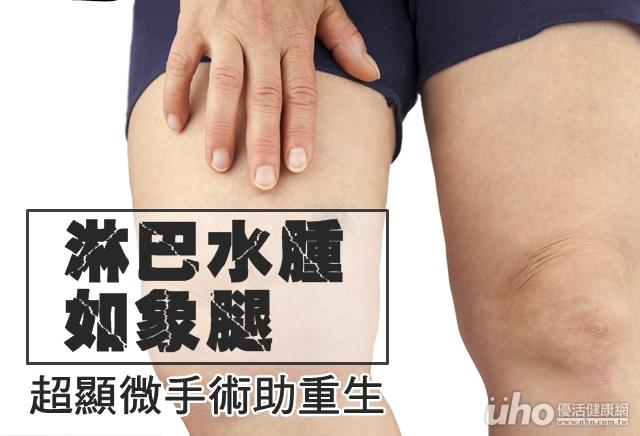 淋巴水肿如象腿 超显微手术助重生