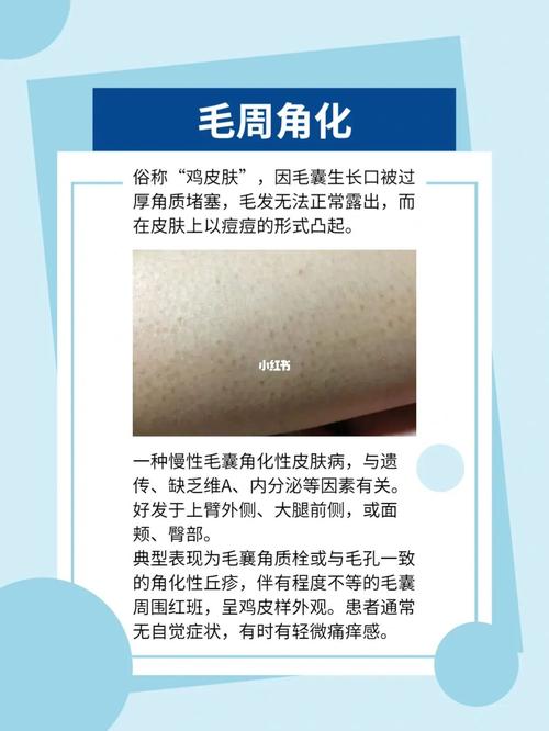 毛周角化_防晒_护肤_清洁_角质层_洗澡刷_熬夜_美妆_个人护理_身体