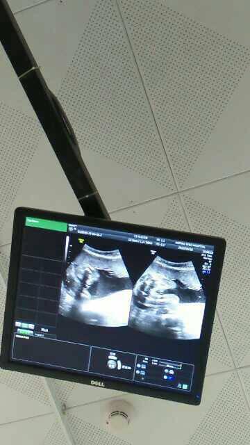 2015-04-22 15:46    浏览  33333  推荐回答 彩超图看不到性别