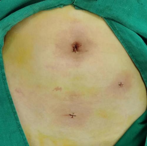 孙清政:不开刀的小儿阑尾炎切除术