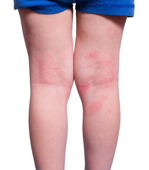 特应性皮炎的特点是皮肤干燥症及瘙痒症,是皮肤炎症反复出现的慢性