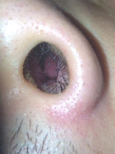 请问我这是什么病,需要如何治疗?鼻孔深处里有肉球一样的东西,不疼