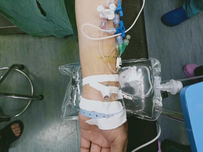 手术前行桡动脉穿刺为患者行有创血压监测.