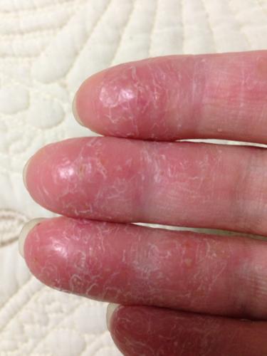 手指干裂脱皮,痛痒,这是什么病,怎么治?