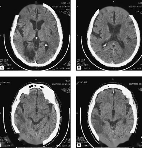 简明又详细的头部ct读片详解,收藏!_脑室
