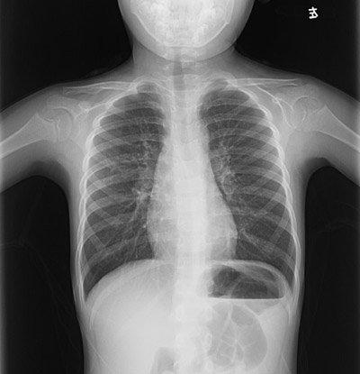 心脏长反了农家男童成功"补心"