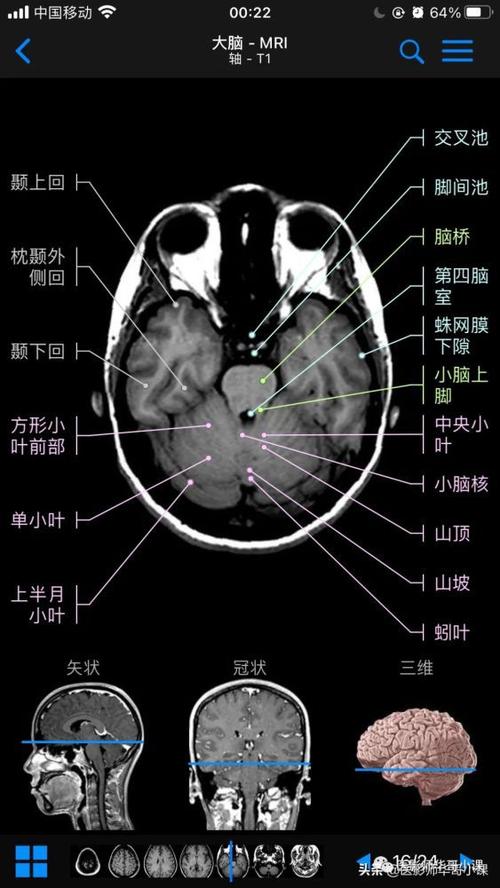 高清mri图颅脑磁共振mri解剖