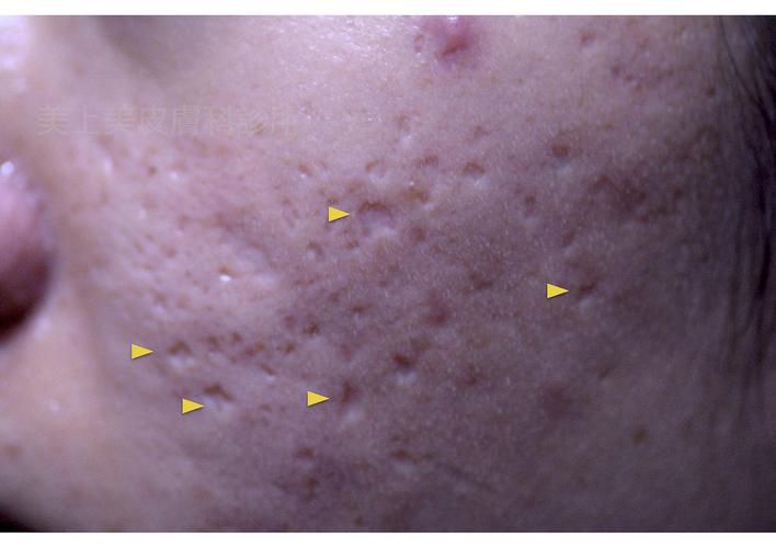 痘疤治疗中棘手的凹痘疤要靠磨皮,利用磨皮把不平的凹痘疤表皮气化,给