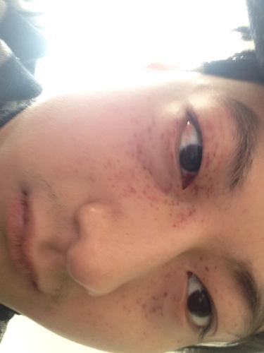 喝酒后第二天眼睛周围起大量红点,都两天了