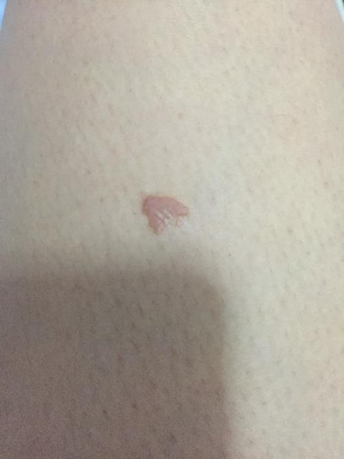 大腿上这个是寻常疣么?