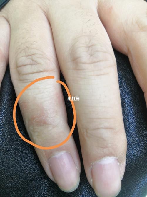 珀芙研 前段时间手上有一块皮癣边缘爆皮一直都不好,严重时候海出水