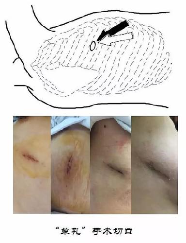 胸外科手术发展篇从开胸到开孔