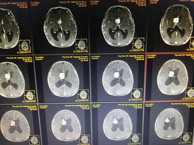 室管膜瘤(侧脑室,双侧,右侧为主,左侧囊变)