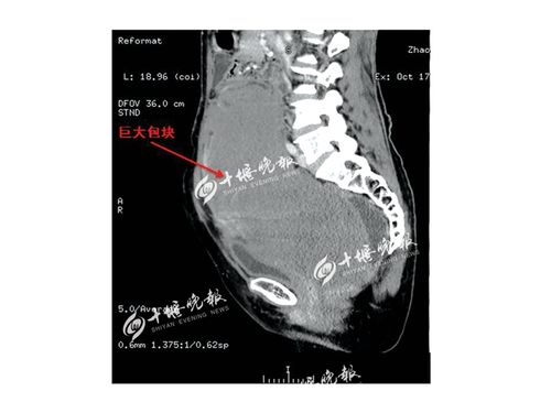 直径31厘米,如篮球般大小,在腹腔内犹如孕育了几个月的胎儿,你见过