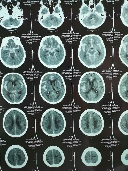 ct显示蛛网膜下腔出血