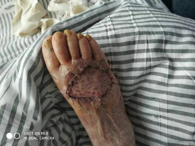 一例高龄患者足背植皮成功