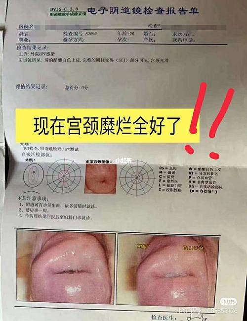 轻度宫颈糜烂,现在全好了_宫颈糜烂_性生活_妇科_医疗