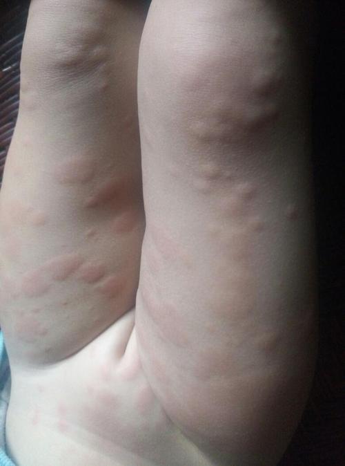 孩子身上起红色小疙瘩,都是一片片的,什么原因?