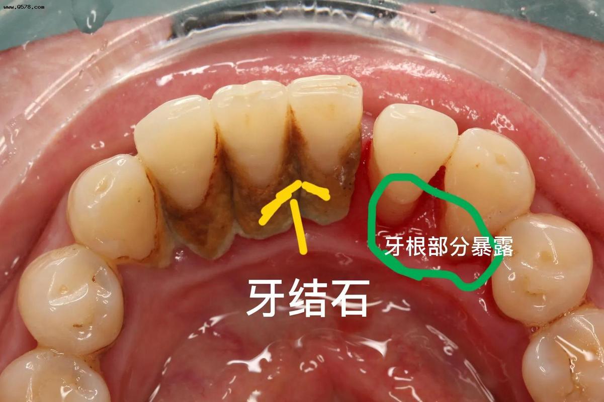 老掉牙其实是一种病不能洗牙洗牙了牙齿就松了到底有没有道理