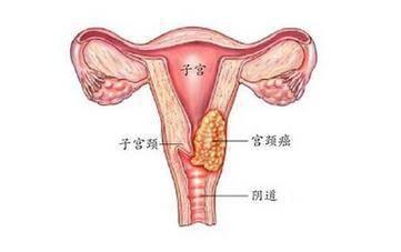 6岁女儿喉咙痒,全家查出感染hpv,得知原因后,妈妈自责