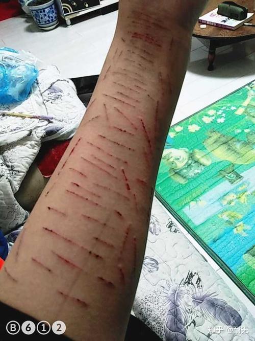 是不是自残过的人都会对自残上瘾,然后不管疼痛,不论伤疤,纵使知道会