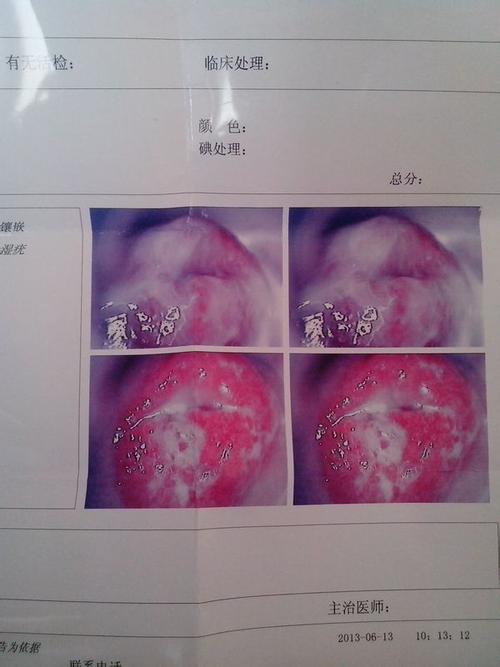 怀孕了,今天去一家私人医院,他告诉我重度宫颈糜烂,让