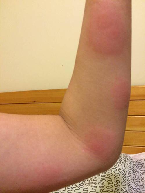 被南方无名虫咬到了