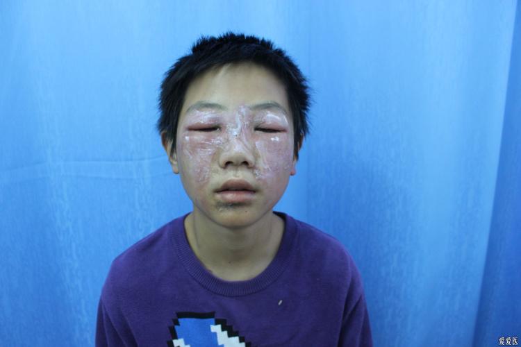 [皮肤病] 面部隐翅虫皮炎