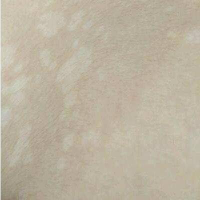 汗斑?花斑癣?这种疾该如何治疗?