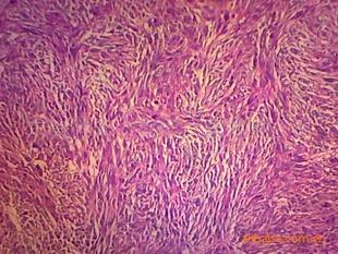 人体病理学纤维肉瘤切片