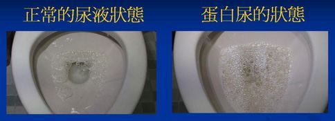 尿尿泡沫增加,或是有水肿的情形,及早至肾脏科就医检查是否有蛋白尿