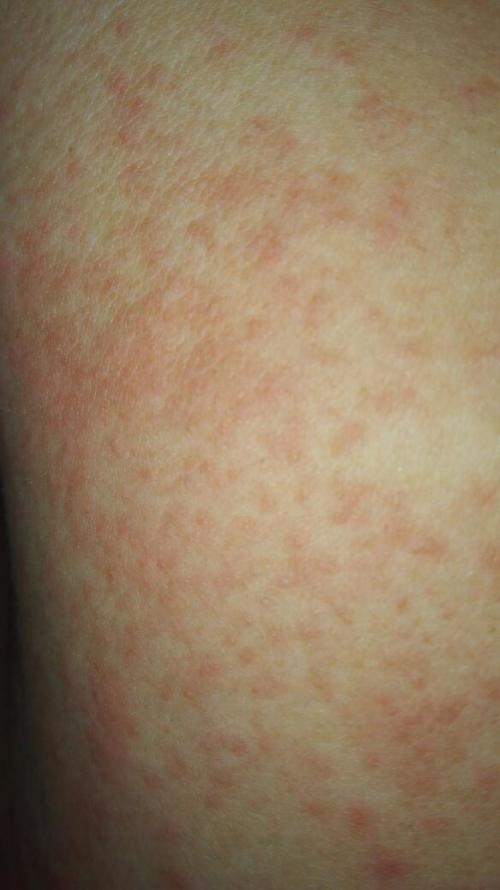 皮肤起了好多红疙瘩一片,右侧胸前早上起来时没有,穿衣服后感觉有点痒