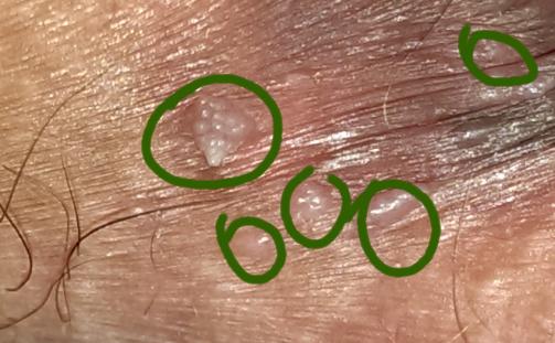 不是专业的,不要误导我,就一个问题,到底是不是尖锐湿疣,患者女性