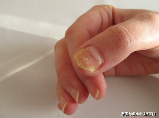 警惕四种指甲特征可能是糖尿病的先兆尽快测测血糖