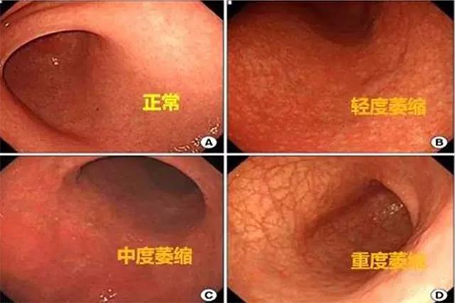 张璐教授谈慢性萎缩性胃炎的中医研究中篇
