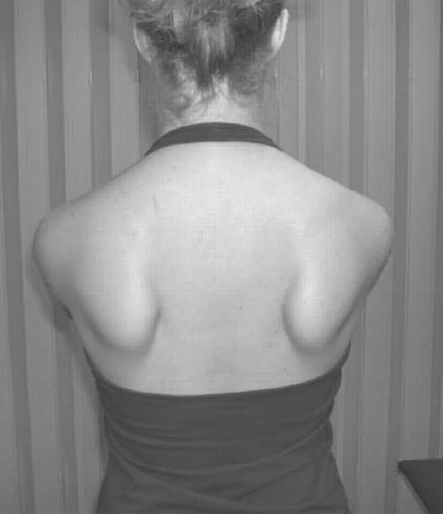 出拳无力还可能与肩胛骨有关