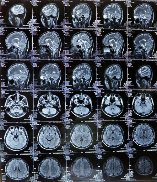 mri4040:男_34岁左侧上肢活动不利(头部ct mri平扫,增强)