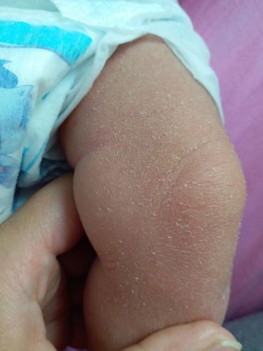 宝宝身上这个是宝宝换胎皮吗?