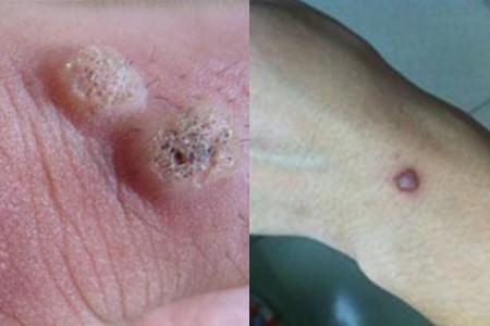 【图】鱼鳞痣的治疗方法 这三种较常见