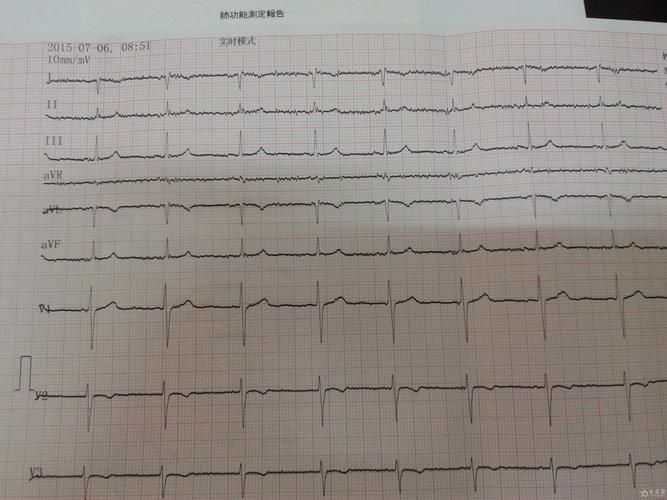 这个心电图是右位心吗,要怎么诊断呢