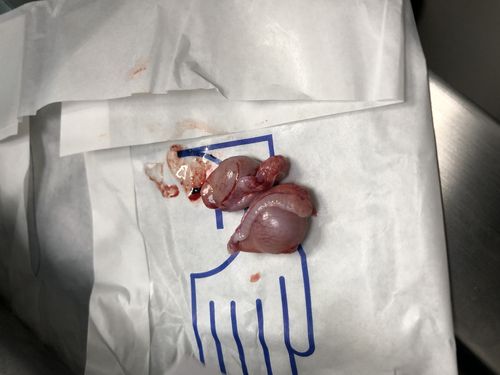 右侧是皮下的那颗蛋蛋 可以看出比正常蛋蛋是要小一些的