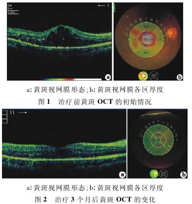 雷珠单抗联合氪激光光凝对黄斑水肿的疗效分析
