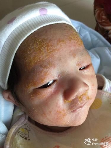 一个月七天我二宝湿疹太严重了,宝妈们有什么办法[哭]