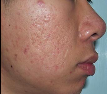 主页 美容性疤痕 青春痘疤痕 青春痘疤痕是因为感染发炎或外力挤压所