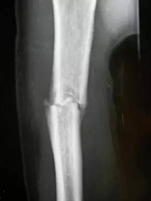 伤筋动骨一百天的思考