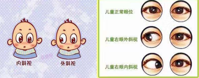 家长必读|孩子为什么容易发生斜视?教您一招,简单自测