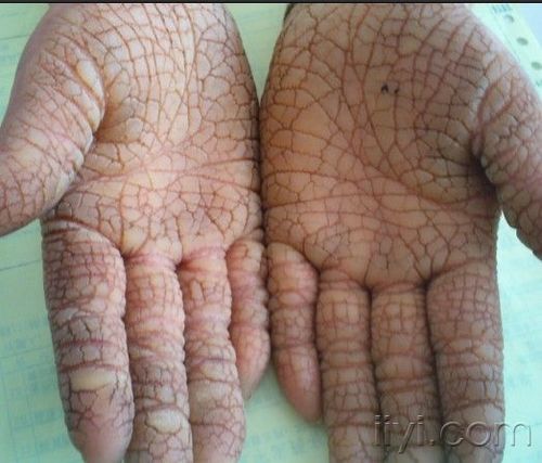 遗传性掌跖角化症