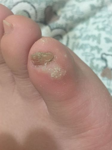 问下医生,我脚趾上长的是什么,我挑破过,可是不是水泡,很疼,前两天长