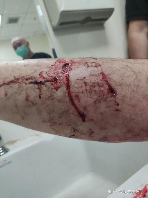 前同事下班途中被狼狗咬伤,伤口情况惨不忍睹