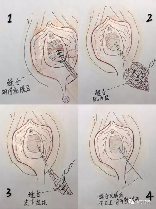顺产还要挨一刀?会阴侧切真的那么可怕吗?
